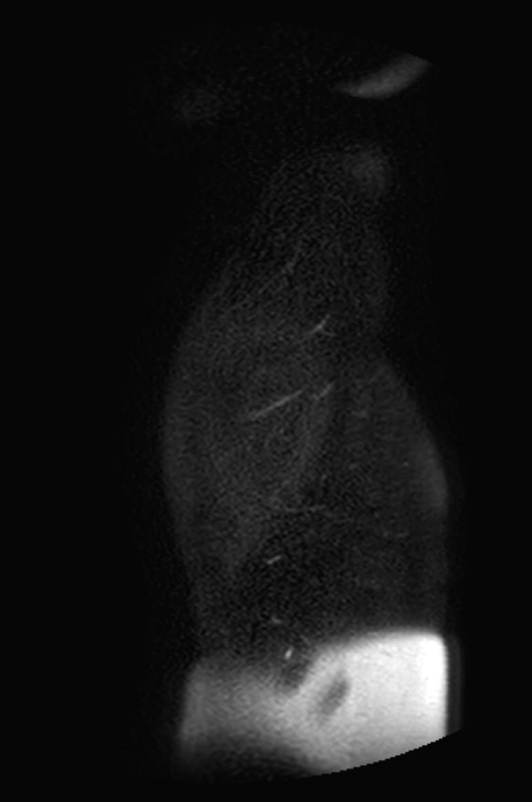 Appendicitis in gravida (MRI) (Radiopaedia 89433-106395 Sagittal T2 SPAIR 60).jpg