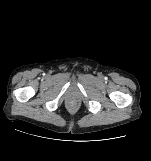 File:Appendicitis with localized perforation and abscess formation (Radiopaedia 49035-54130 A 90).jpg