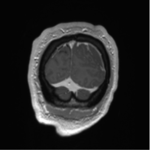 Arachnoid cyst with subdural hematoma (Radiopaedia 85892-101743 Coronal T1 C+ 7).png