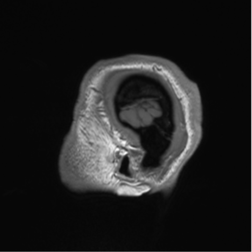 Arachnoid cyst with subdural hematoma (Radiopaedia 85892-101743 Sagittal T1 86).png