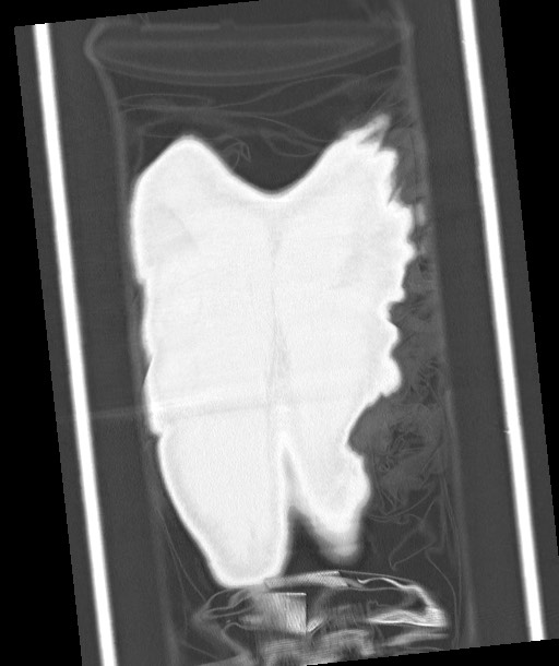 Arrow injury to the chest (Radiopaedia 85367-100975 Coronal lung window 124).jpg