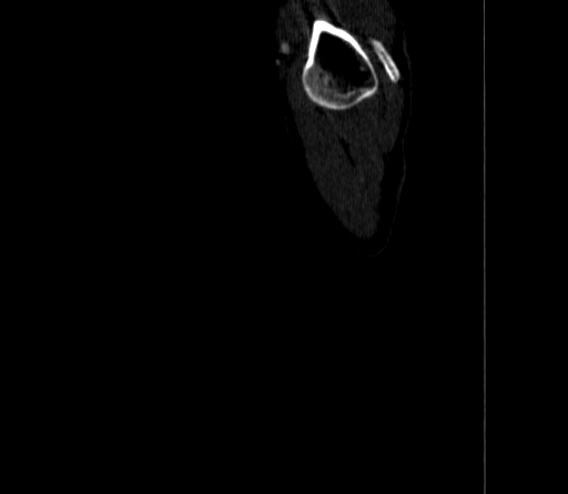 Arteria lusoria (Radiopaedia 88528-105192 C 6).jpg