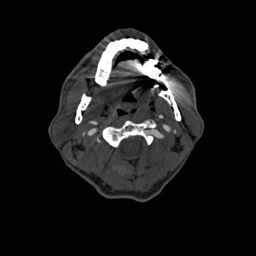 Artery of Percheron infarct (Radiopaedia 48088-52894 A 90).jpg