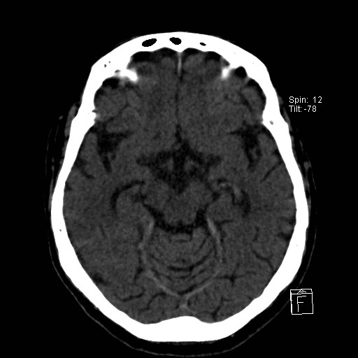 File:Artery of Percheron infarction (Radiopaedia 26307-26439 Axial non-contrast 2).jpg