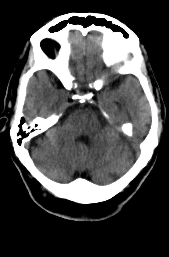 Artery of Percheron infarction (Radiopaedia 80613-94202 Axial non-contrast 64).jpg