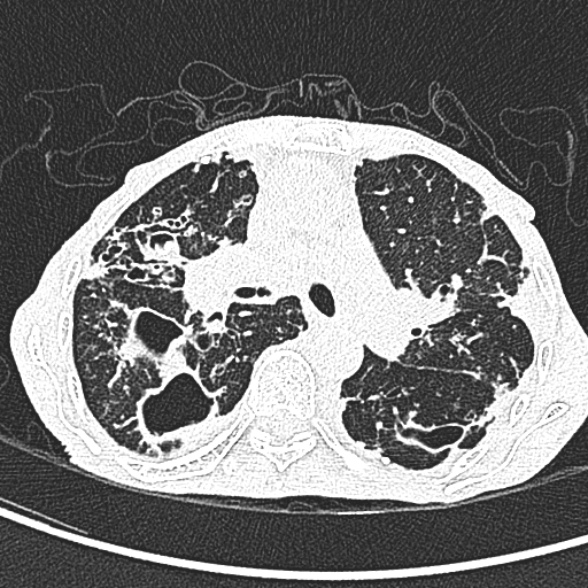Aspergilloma- with Monod sign (Radiopaedia 44737-48532 Axial lung window 109).jpg