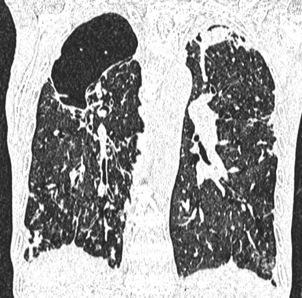 Aspergilloma- with Monod sign (Radiopaedia 44737-48532 Coronal lung window 302).jpg