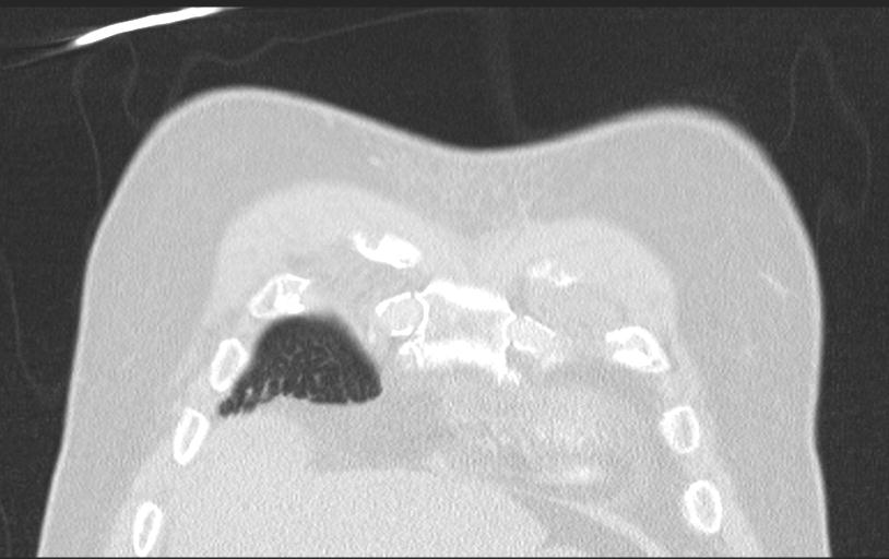 Aspirated tooth (Radiopaedia 28584-28844 Axial lung window 26).jpg