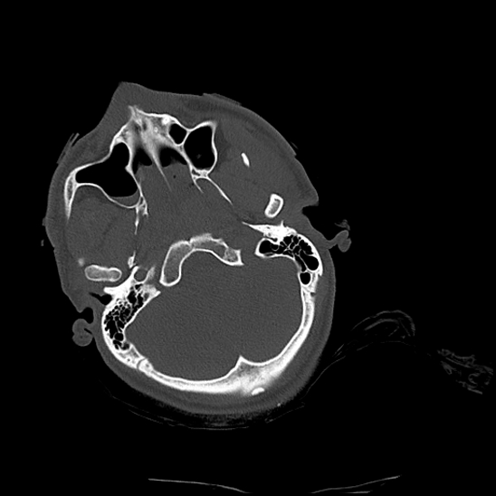 Atlanto-occipital dissociation (Traynelis type 1), C2 teardrop fracture, C6-7 facet joint dislocation (Radiopaedia 87655-104061 Axial bone window 6).jpg