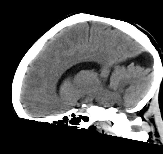 File:Atretic encephalocoele with inferior vermis hypoplasia (Radiopaedia 30443-31107 C 17).jpg