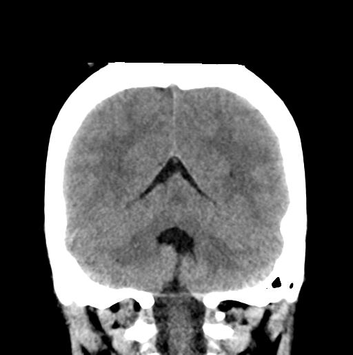 File:Atretic encephalocoele with inferior vermis hypoplasia (Radiopaedia 30443-31107 Coronal non-contrast 29).jpg