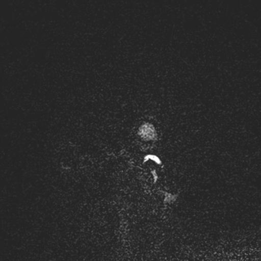 Atretic encephalocoele with inferior vermis hypoplasia (Radiopaedia 30443-31108 Sagittal FLAIR 156).jpg