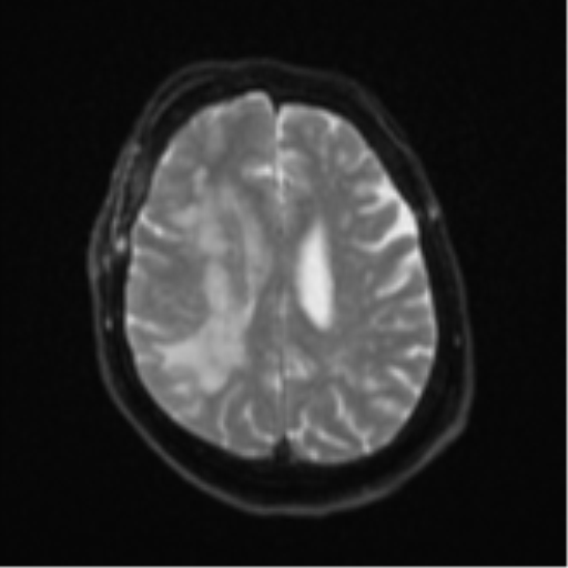 Atypical meningioma (WHO Grade II) (Radiopaedia 54742-60981 Axial DWI 19).png
