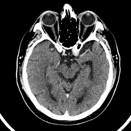 Atypical meningioma (WHO grade II) with brain invasion (Radiopaedia 57767-64728 Axial C+ 35).png
