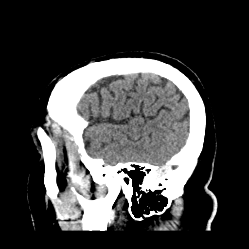 Atypical meningioma (WHO grade II) with brain invasion (Radiopaedia 57767-64728 Sagittal C+ 44).png