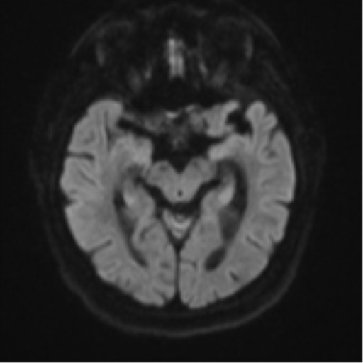 File:Atypical meningioma (WHO grade II) with brain invasion (Radiopaedia 57767-64729 Axial DWI 42).png