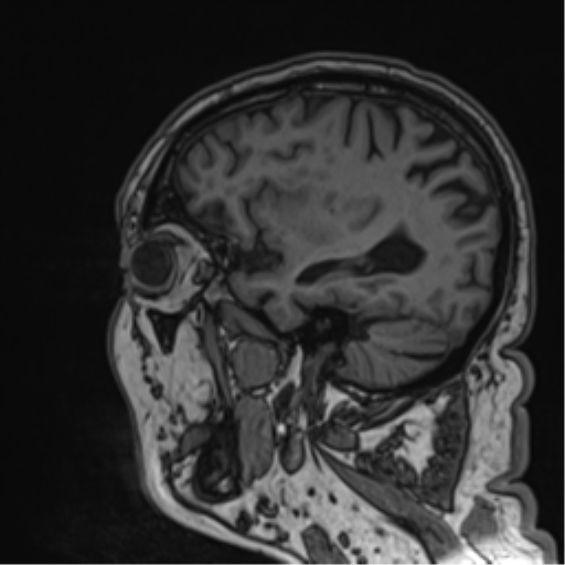 Atypical meningioma (WHO grade II) with brain invasion (Radiopaedia 57767-64729 Sagittal T1 24).png