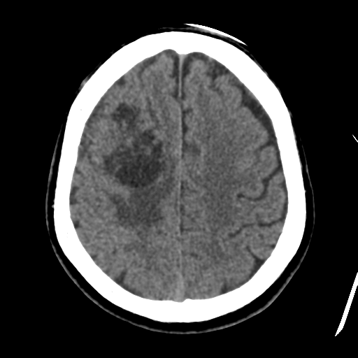 Atypical meningioma (WHO grade II) with osseous invasion (Radiopaedia 53654-59715 Axial non-contrast 39).png