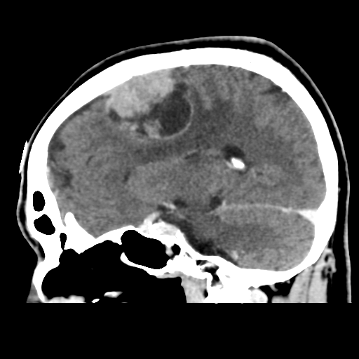 Atypical meningioma (WHO grade II) with osseous invasion (Radiopaedia 53654-59715 G 23).png
