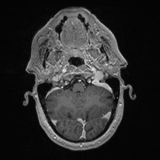 Atypical meningioma (grade II) - en plaque (Radiopaedia 29633-30147 Axial T1 C+ 39).jpg