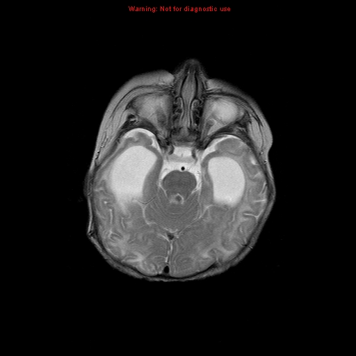 File:Atypical teratoid rhabdoid tumor (Radiopaedia 10712-11183 Axial T2 12).jpg