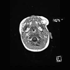 File:Atypical teratoid rhabdoid tumor (prenatal US and neonatal MRI) (Radiopaedia 59091-66388 Axial T1 C+ 5).jpg