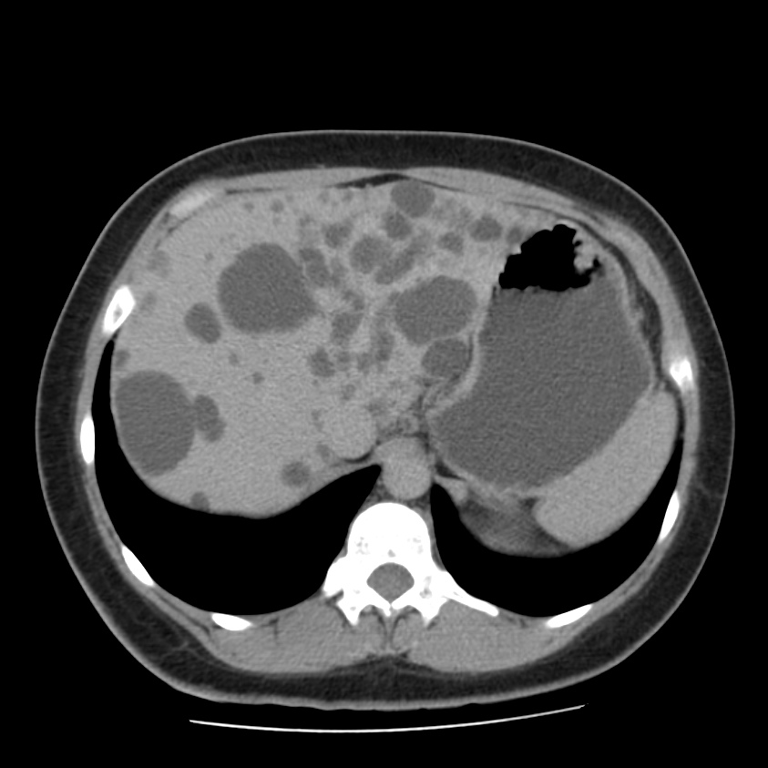 Autosomal dominant polycystic kidney disease (Radiopaedia 23061-23093 C+ delayed 15).jpg