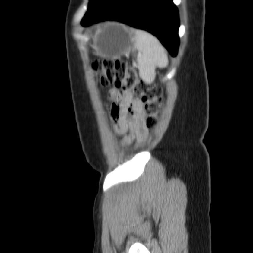 Autosomal dominant polycystic kidney disease (Radiopaedia 23061-23093 F 50).jpg