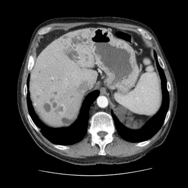 Autosomal dominant polycystic kidney disease (Radiopaedia 27851-28094 B 54).jpg