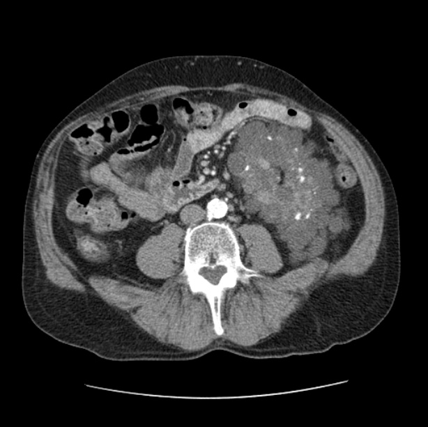 Autosomal dominant polycystic kidney disease (Radiopaedia 27851-28094 B 82).jpg