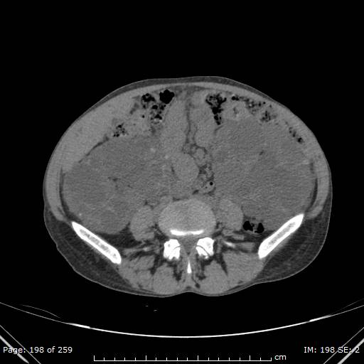 Autosomal dominant polycystic kidney disease (Radiopaedia 44122-47684 Axial non-contrast 71).jpg