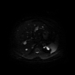 File:Autosomal dominant polycystic kidney disease (Radiopaedia 50259-55611 Axial DWI 13).jpg