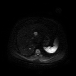 File:Autosomal dominant polycystic kidney disease (Radiopaedia 50259-55611 Axial DWI 46).jpg