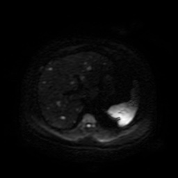 Autosomal dominant polycystic kidney disease (Radiopaedia 50259-55611 Axial DWI 48).jpg