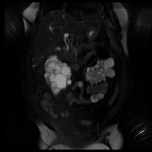 File:Autosomal dominant polycystic kidney disease (Radiopaedia 50259-55611 Coronal T2 fat sat 16).jpg