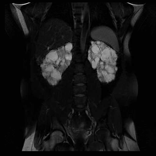 File:Autosomal dominant polycystic kidney disease (Radiopaedia 50259-55611 Coronal T2 fat sat 24).jpg