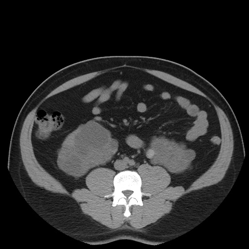 File:Autosomal dominant polycystic kidney disease (Radiopaedia 50259-55612 Axial non-contrast 50).jpg