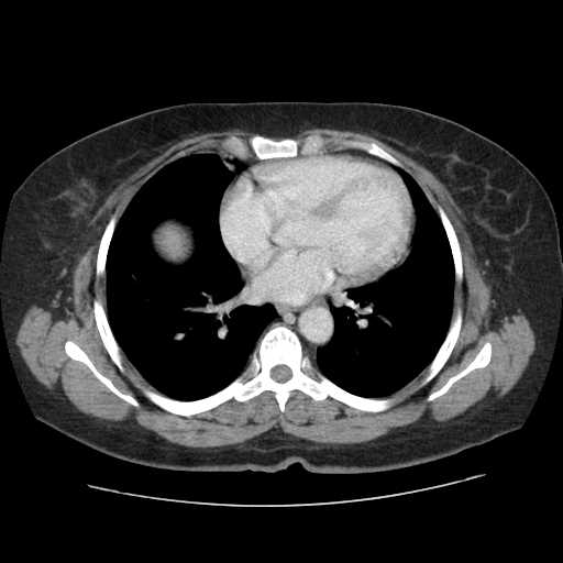 File:Autosomal dominant polycystic kidney disease with hepatic involvement (Radiopaedia 32693-33662 B 2).jpg