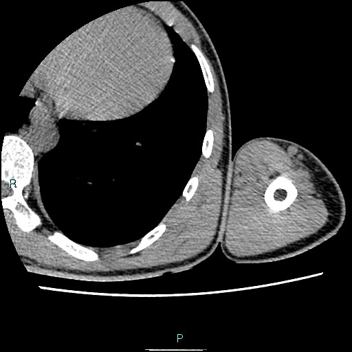 File:Avascular necrosis after fracture dislocations of the proximal humerus (Radiopaedia 88078-104653 D 108).jpg