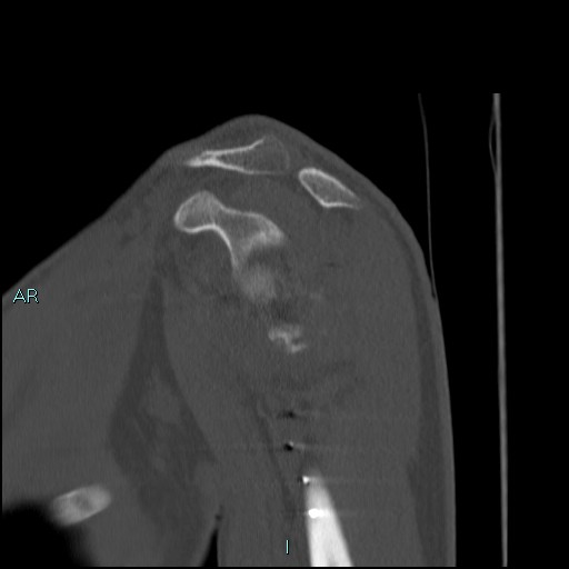 Avascular necrosis after fracture dislocations of the proximal humerus (Radiopaedia 88078-104653 Sagittal bone window 33).jpg