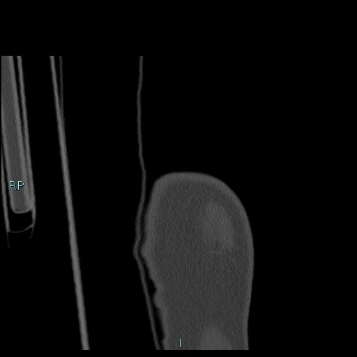 Avascular necrosis after fracture dislocations of the proximal humerus (Radiopaedia 88078-104655 Coronal bone window 12).jpg