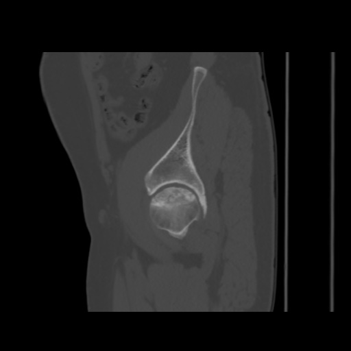 Avascular necrosis of the hip (Radiopaedia 61503-69467 B 14).jpg
