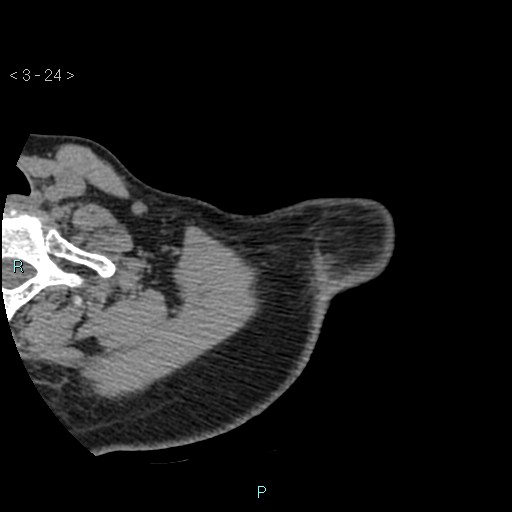 File:Avascular necrosis of the shoulder - Cruess stage I (Radiopaedia 77674-89887 Axial soft tissues 8).jpg