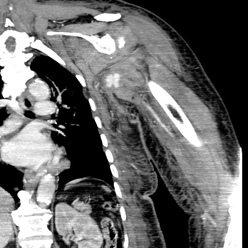 File:Axillary arterial pseudoaneurysm (Radiopaedia 24925-25195 B 12).jpg