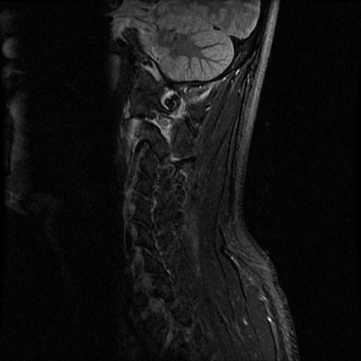 File:Axis fracture - MRI (Radiopaedia 71925-82375 Sagittal STIR 9).jpg