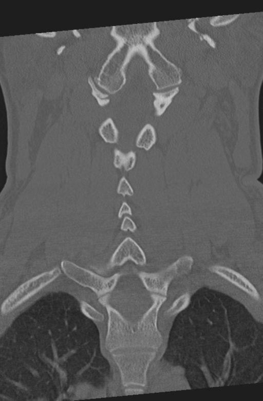 Axis peg fracture (type 3) and atlas lateral mass (type 4) fracture (Radiopaedia 37474-39324 Coronal bone window 30).png
