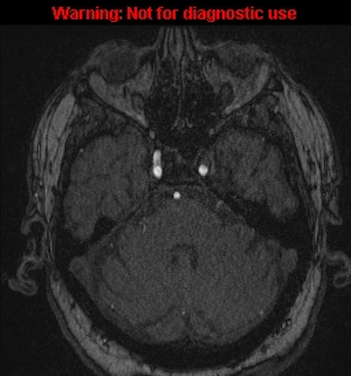 Azygos anterior cerebral artery (Radiopaedia 59325-66677 Axial MRA 42).jpg