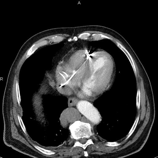 File:Azygos continuation of the inferior vena cava (Radiopaedia 18537-18404 C+ arterial phase 41).jpg