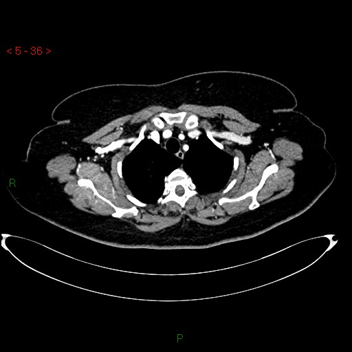File:Azygos fissure and lobe (Radiopaedia 47620-52278 A 22).jpg