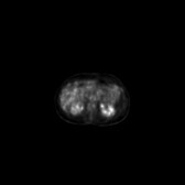 B-cell lymphoma of the mesentery (Radiopaedia 65743-74868 18F-FDG PET-CT 151).jpg
